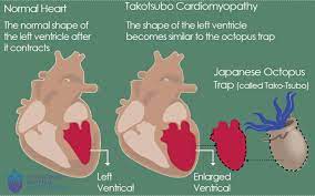 normal heart and Takotsubo