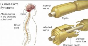 gullain barre syndrome