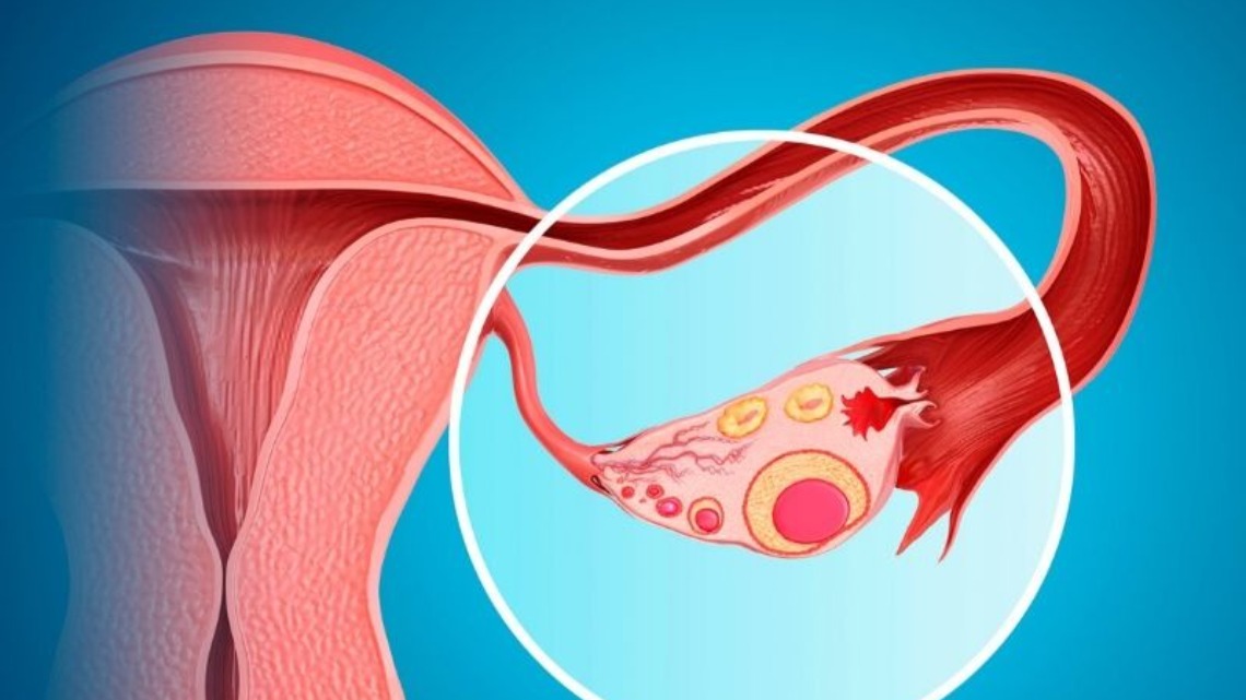 pcos or polycystic ovary syndrome