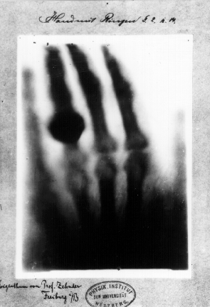 First medical X-ray by Wilhelm Röntgen of his wife Anna Bertha Ludwig's hand