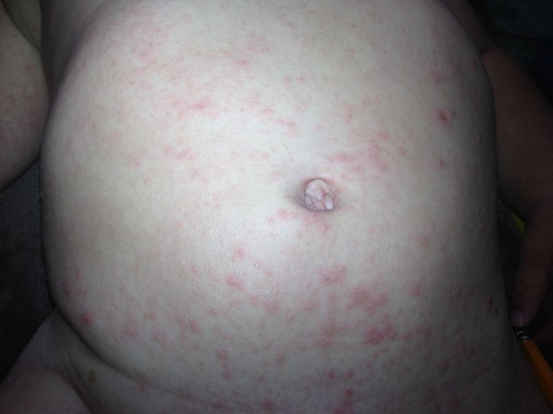 Health article on Chicken Pox (1)