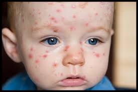 Health article on Chicken Pox (2)
