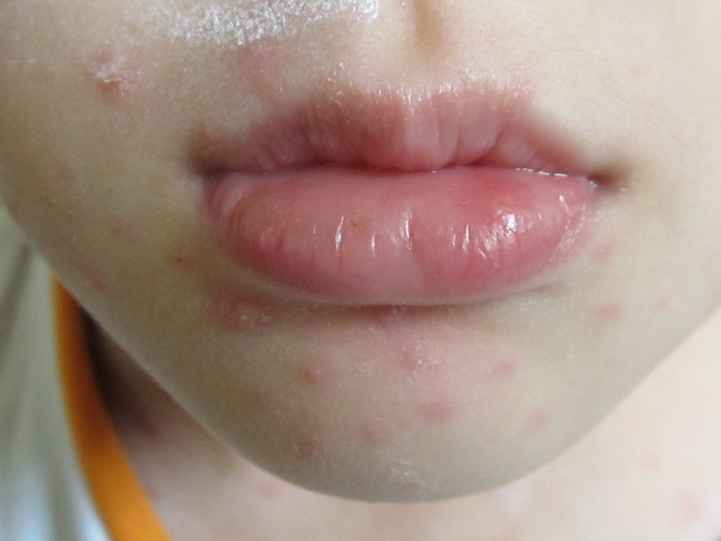 Health article on Chicken Pox (3)