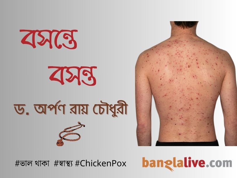 Health article on Chicken Pox cover